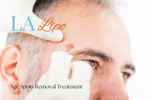 What Are the Most Effective Treatments for Age Spots Mitcham?