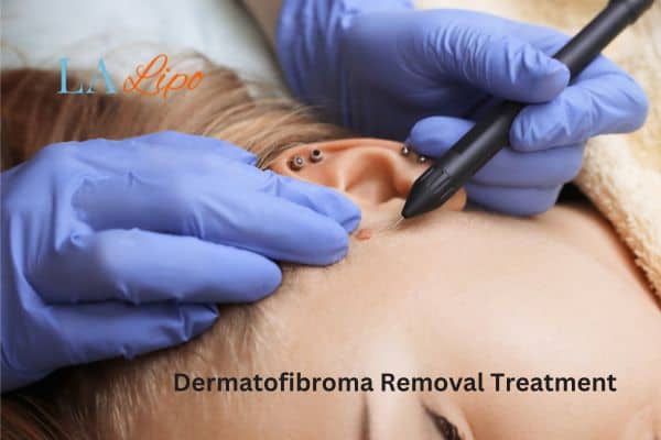 Dermatofibroma Removal Treatment Mitcham