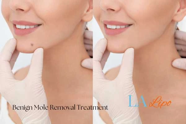 Before-and-after results following benign mole-removal treatment Mitcham