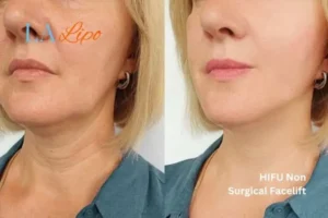 hi-fu for wrinkles Mitcham before and after results