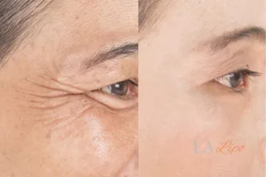 Before and after results of woman - HI-fu wrinkles reduction treatment Mitcham