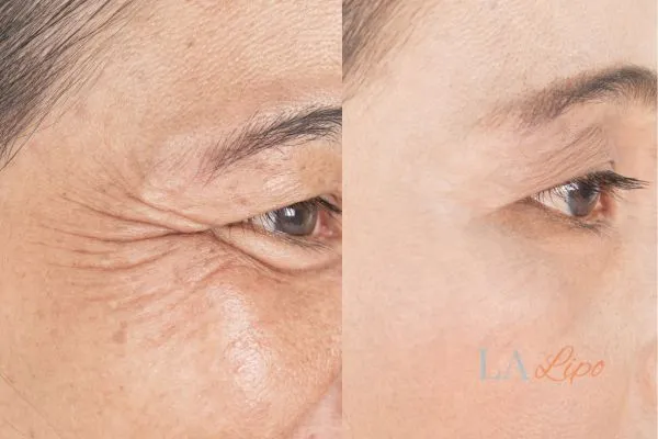 Before and after results of woman - HI-fu wrinkles reduction treatment Mitcham