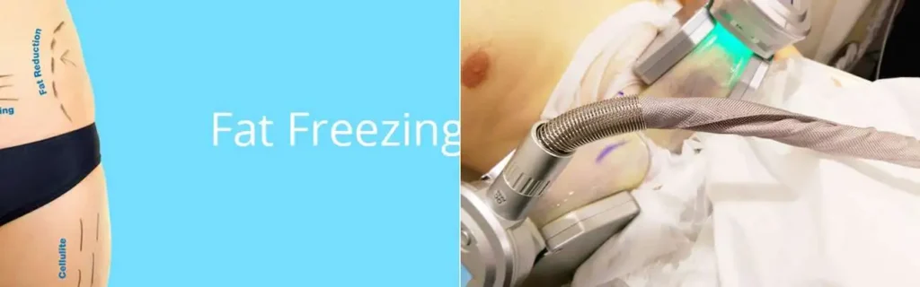 Fat freezing Mitcham on multiple areas of the body
