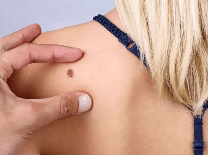 woman having mole removal Mitcham consultation before treatment.