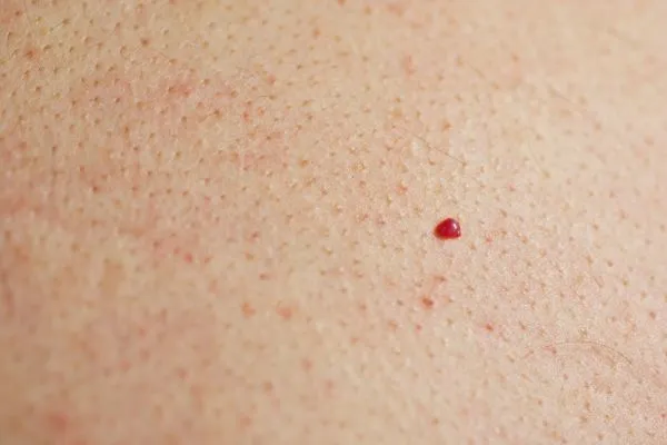 close up of a cherry angioma Mitcham