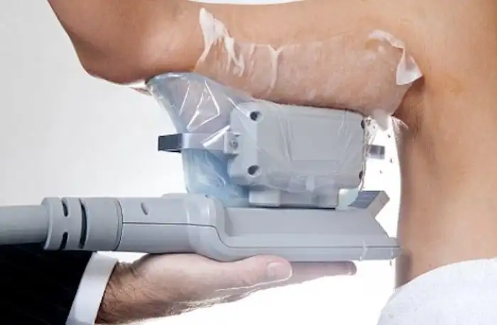 Picture of fat freezing Mitcham on the upper arms.