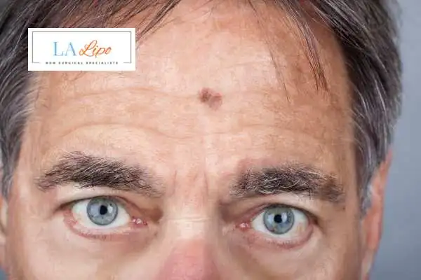 Solar Lentigo Removal Mitcham image of man with mark on his forehead