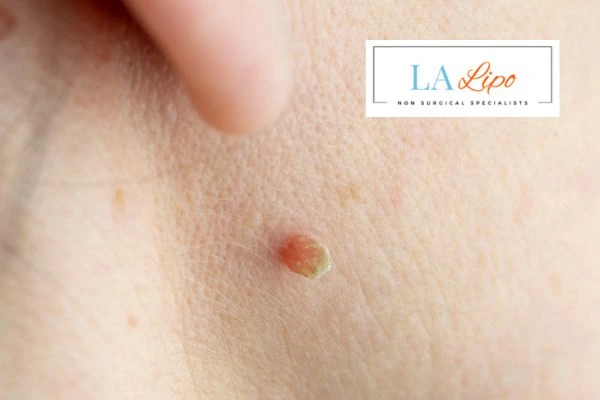 Book skin tag removal Mitcham today speak to our team now!