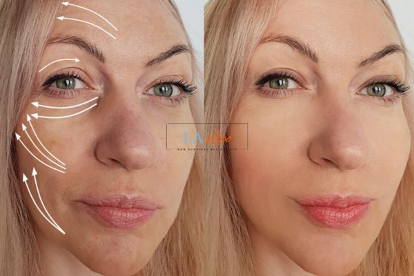 Morpheus 8 results Mitcham face lift.