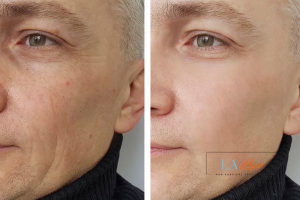 See the amazing results of Morpheus8 Treatment Mitcham!