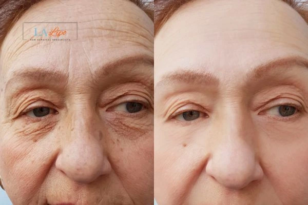 The powerful benefits of Morpheus8 Treatment Mitcham - Call Our team today!