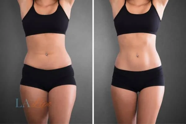 before and after results of non-surgical treatment to help a woman's body image and mental health Mitcham