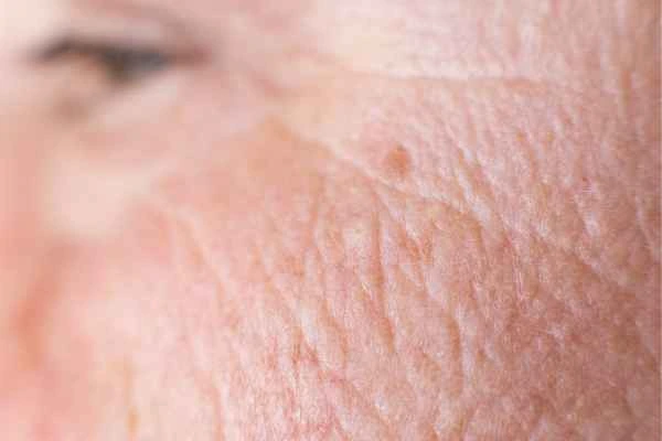 close up picture of a woman's face showing an age spot Mitcham