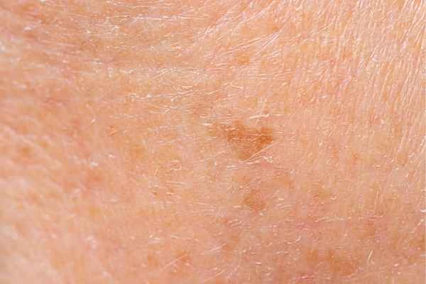 close up picture of age spots Mitcham