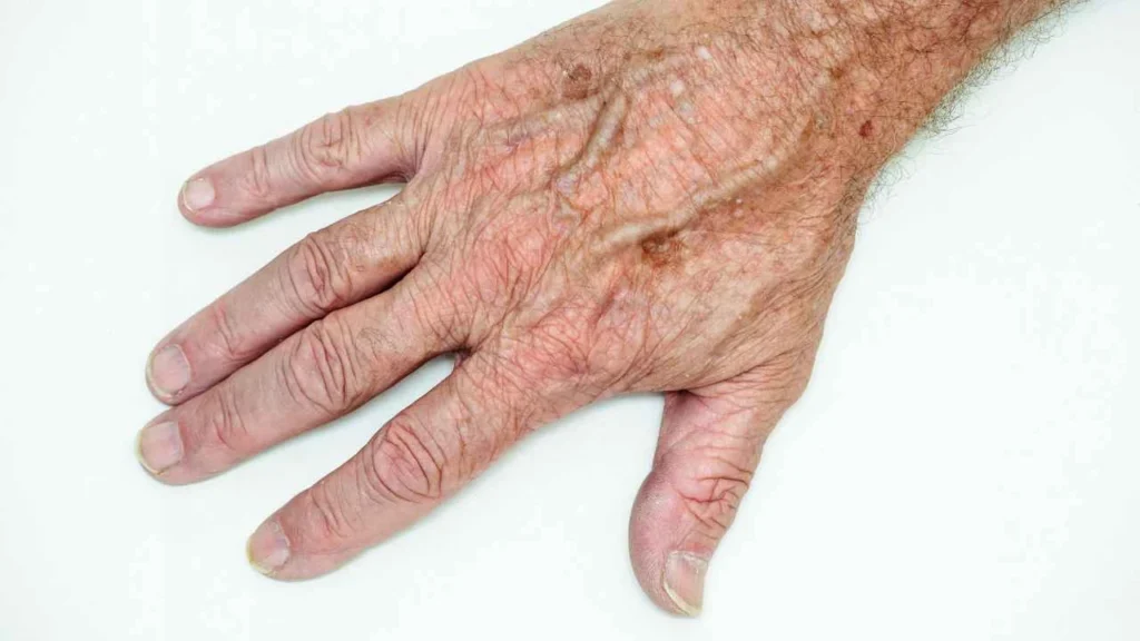 Male hand showing age spot Mitcham