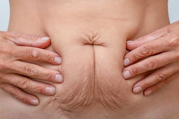 Image of a woman's stomach with loose skin - example of skin tightening Mitcham options