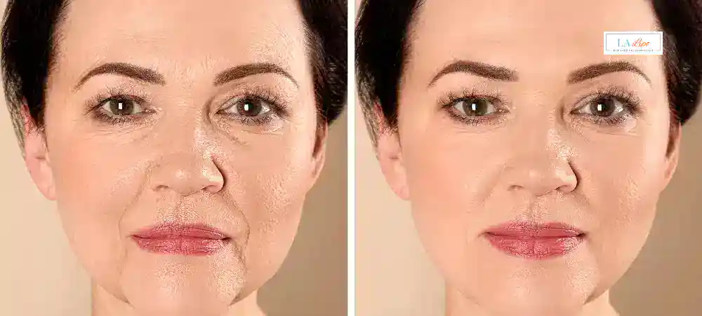 How Long Does It Take to See Results and How Long Do They Last Mitcham?