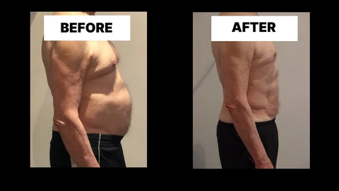What Symptoms Can Diastasis Recti Cause in Men? Weak Core, Back Pain and Poor Posture Mitcham